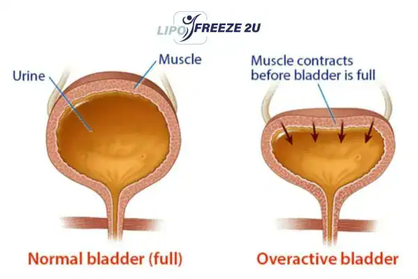 diagram of overactive bladder treatment Rhyl