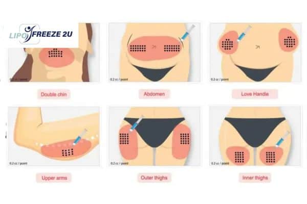 Benefits of Choosing Aqualyx for Fat Reduction Rhyl
