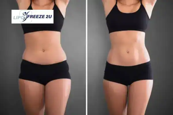 How Can LIPO FREEZE 2U Support Your Post-Pregnancy Body Recovery Rhyl?