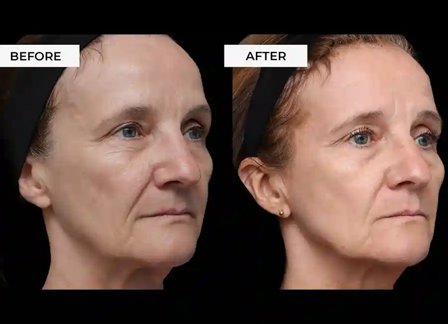 How Many RF Microneedling Sessions Will You Need to See a Difference Rhyl?