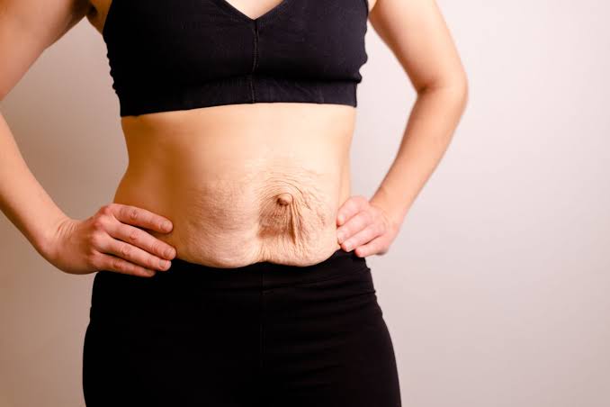 Is Surgery Really the Only Way to Repair Diastasis Recti Rhyl?