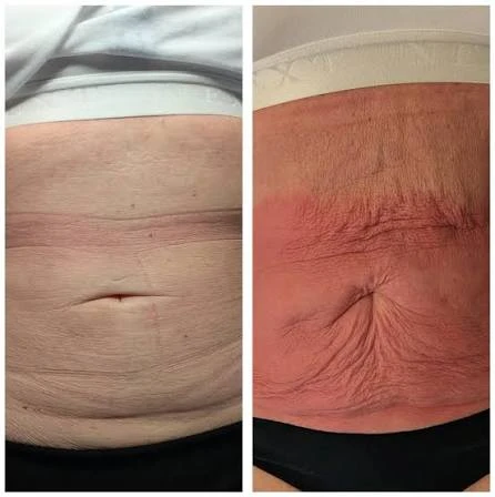 How Does RF Microneedling Improve Crepey, Thin and Uneven Skin Texture Rhyl?