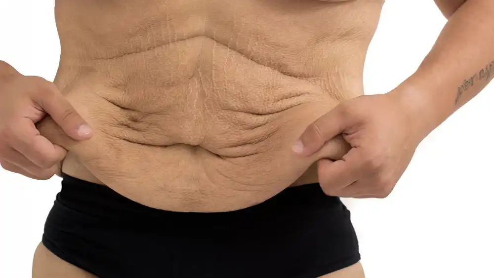 Why Does Weight Loss Medication Leave Some People With Loose or Sagging Skin Rhyl?